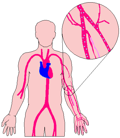 decompression sickness