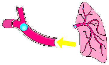 arterial gas embolism