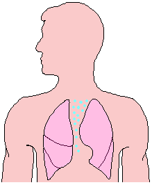 mediastinal emphysema