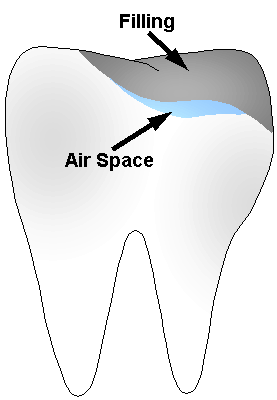 tooth with bad filling