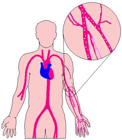 Illustration of decompression sickness