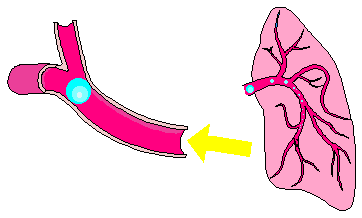 Arterial Gas Embolism