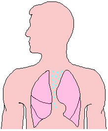 Illustration of mediastinal emphysema
