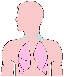 Illustration of subcutaneous emphysema