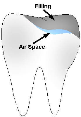 Illustration of tooth air space